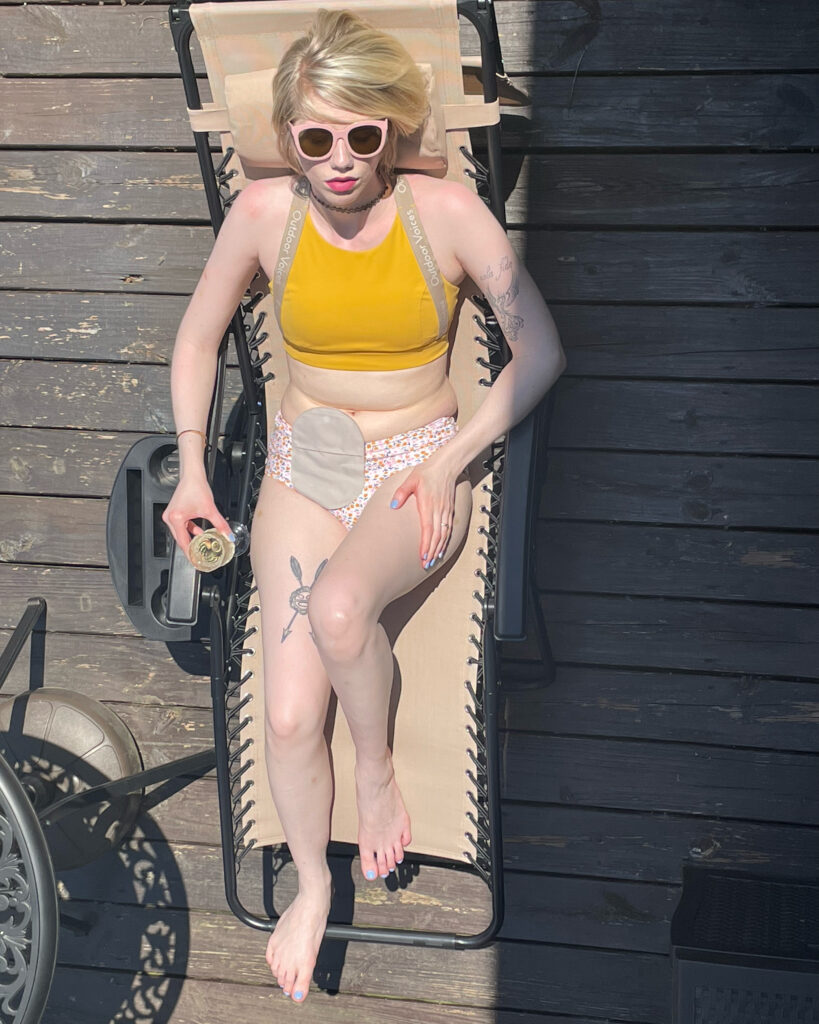 overhead shot of cassandra, who lays on a lounge chair sporting a yellow sports bra and floral swimsuit bottom that reveals her gray ostomy bag affixed to the bottom right of her abdomen